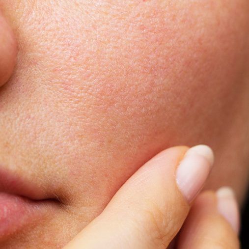 Comment lutter contre les pores dilatés avec le Peeling Perfecteur